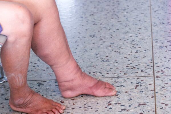 Primer plano de piernas y pies con signos de hinchazón